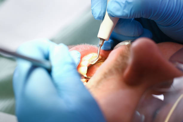 Best Emergency Wisdom Teeth Removal in Valdosta, GA